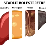 Ciroza jetre – uzroci, simptomi, liječenje i faze
